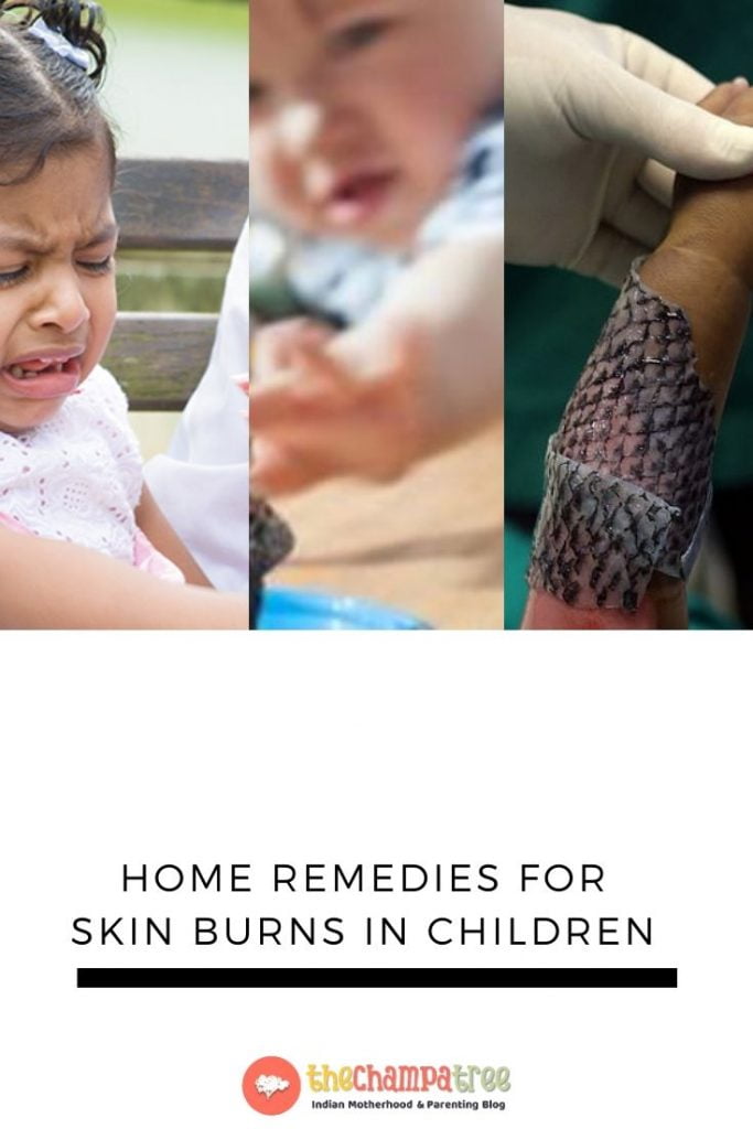 Home Remedies for burns - Three kids with skin burns