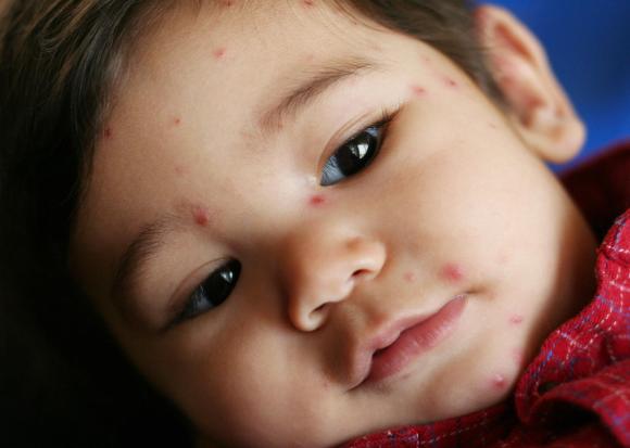 Common Allergies in Kids 02