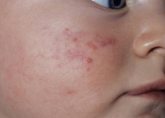 Common Allergies in Kids 03