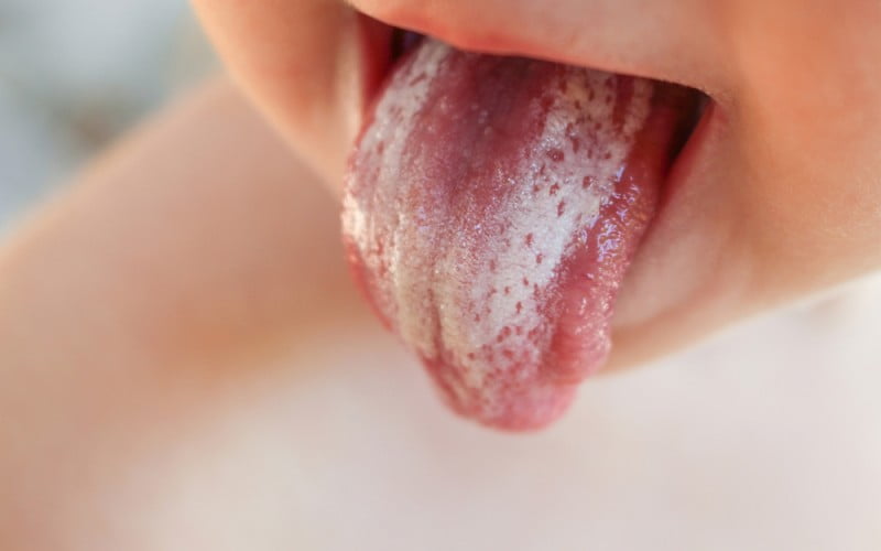 Newborns Tongue And Avoid Mouth Thrush 01
