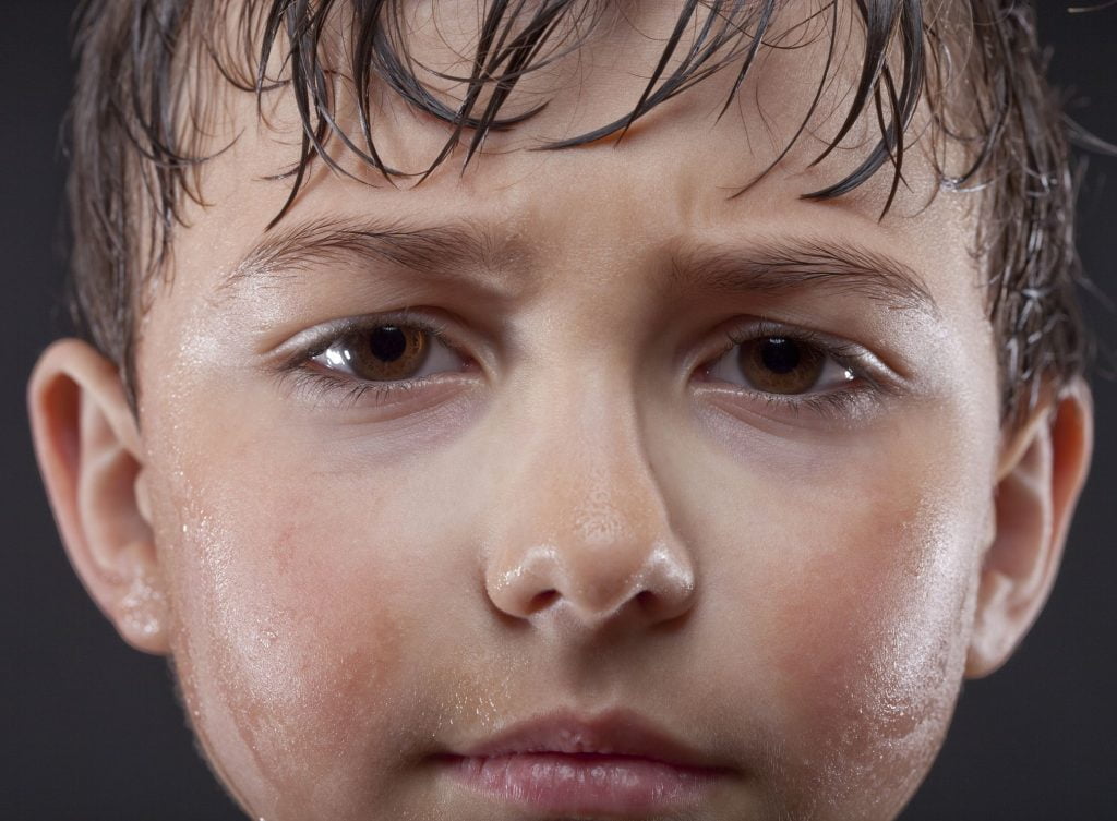 Hyperhidrosis - Child sweating