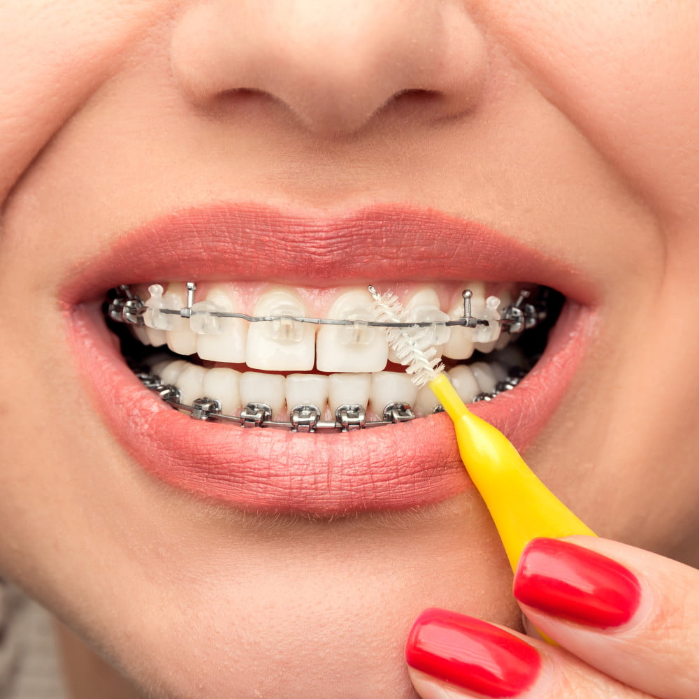 Flossing when you have dental braces