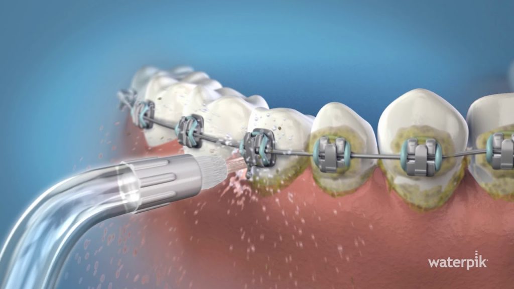 Flossing with waterpik