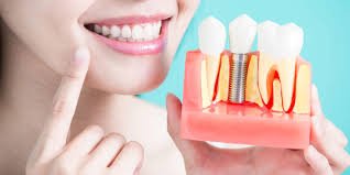Implant of tooth - Dental implant
