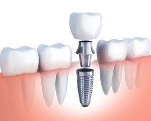 Implant of tooth - Screw attached to implant