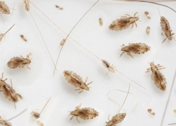 Home Remedies For Lice! Do They Really Work?