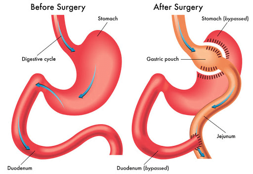 Bariatric Surgery - before and after