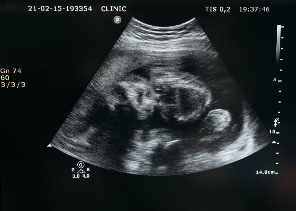 How To Increase Fetal Weight During Pregnancy For A Healthy Birth Weight- Ultrasound of human fetus